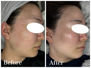 ノア 新宿(Noa)/ハーブピーリング＋マシン 6回