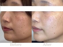 ブルースター/ほうれい線（30代）