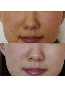 トラット エステアンドアイズ(tratto)/20代　お客様症例写真