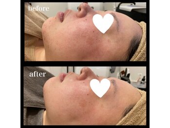 シュバル(CHEVAL)/BBL6回照射後