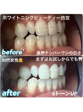 ホワイトニングビューティー 西宮店/ビフォーアフター