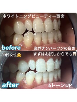 ホワイトニングビューティー 西宮店/ビフォーアフター