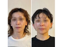 ノアール(Noahr)の雰囲気（頬骨、輪郭、美肌菌エステで褒められ肌へ！）