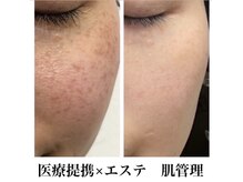 ムーン(MOON)/医療提携肌管理
