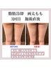 脂肪冷却　両太もも　高出力 ￥22,000-