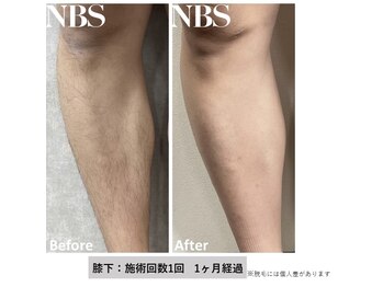 ライチェンド(Reizend)/全身脱毛も大人気◎