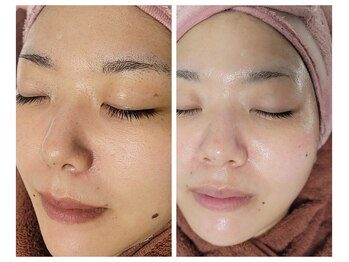 エスボーテ(sbeaute)/プラズマ×炭酸パック×超音波