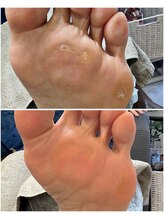 ケアプラス(care plus)/タコ・ウオノメケア