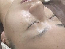 アップル マリー 江別/■糸脱毛