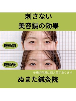 ぬまた鍼灸院/刺さない鍼による美容鍼