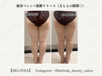 ベリンダ 中崎町店(BELINDA)/【痩身マシン×筋膜リリース】