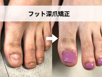 ブルームーンネイルズ(BLOOMOON.nails)/フット深爪矯正