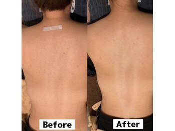 ビューティーデザインアウル(BEAUTY DESIGN OWL)/背中脱毛Before→after