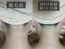 ベルフィーヌ 恵比寿店(BELFINE)/Jerryの脱毛4回施術後の様子