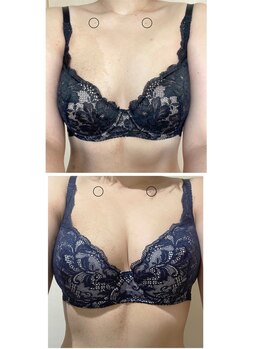 美人バスト 豊橋店/バストアップ症例【バストケア】