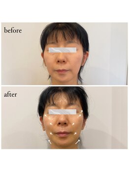 コス(KOS)/美容鍼45本+高周波