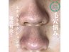 【全顔毛穴取り放題！】毛穴エクストラクション　¥12000→¥8800