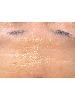 ホウレイ線・たるみ改善！予防ケア