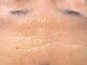 エム(M)の写真/【リフトアップ】1人1人の肌質を見てしっかりカウンセリングし、状態に合わせた施術を行います。肌質改善◎