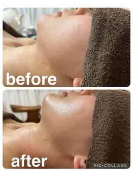 ギンザアール(GINZA R.)/小顔ケア♪