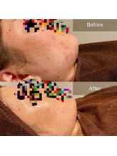 エミルカ 岡山店(EMILUCA)/お顔の施術事例