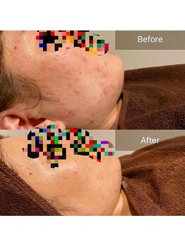 エミルカ 岡山店(EMILUCA)/お顔の施術事例