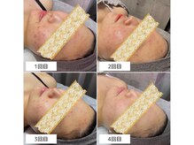 アンリミット 恵比寿店(Unelimit)/ハーブピーリング/ピーリング