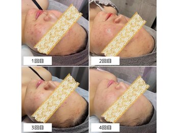 アンリミット 恵比寿店(Unelimit)/ハーブピーリング/ピーリング