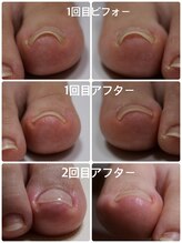 プリード 日進香久山店(PULIDO)/巻き爪ケアフレックスプレート