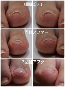 プリード 日進香久山店(PULIDO)/巻き爪ケアフレックスプレート