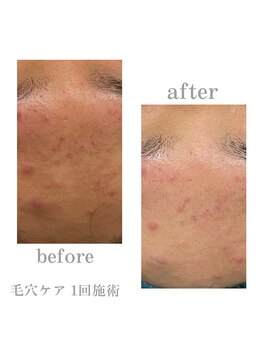 アデージョ アデオス(Ade-jyo.Adeosu)/【エイン毛穴洗浄】