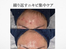 アンドミルル(and Milulu)/【繰り返すニキビ集中ケア】