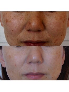 トラット エステアンドアイズ(tratto)/40代　お客様症例写真