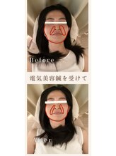 ソメイユ(Sommeil)/美容鍼ビフォーアフター.5