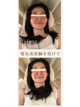 ソメイユ(Sommeil)/美容鍼ビフォーアフター.5