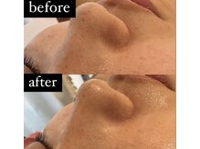 ブルーシー(BLUESEA)/毛穴洗浄