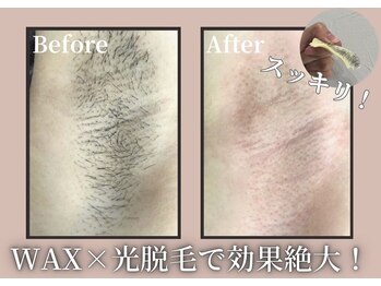 アルゴ 吹田千里山駅前店(ALGO)/大人気WAX脱毛☆