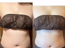 サラン鍼灸院(SARAN都楽鍼灸院)/よもぎ蒸し×エンダモロジー結果