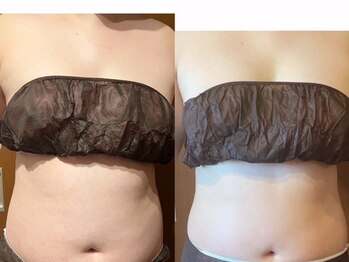 サラン鍼灸院(SARAN都楽鍼灸院)/よもぎ蒸し×エンダモロジー結果