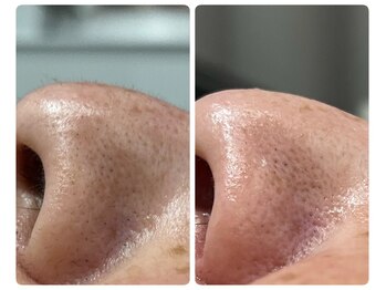 アーヒル(A”-HILU)/ワックス脱毛