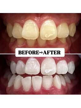 ホワイトニングサロン 豊中/Before&After美白ホワイトニング