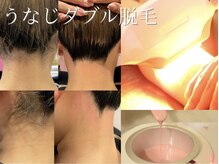 リリィ/うなじダブル脱毛