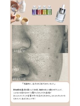 ミーツ(Meets)/諦めていた毛穴があっという間に