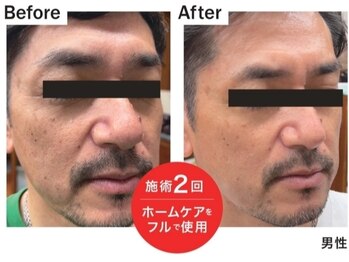 トリアングル(TLIENGLE)/施術×ホームケアフルセット使用