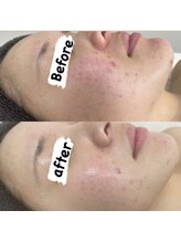 カルディエ(Cardie)/肌質改善　ビフォーアフター