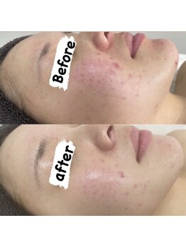 カルディエ(Cardie)/肌質改善　ビフォーアフター