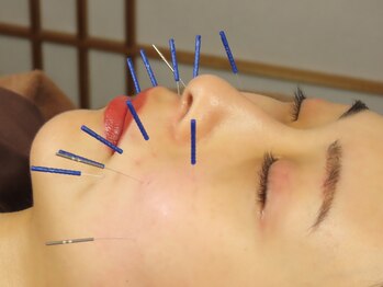 サンクエール 代官山鍼灸院(CINQ AILES)/施術風景　ほうれい線改善