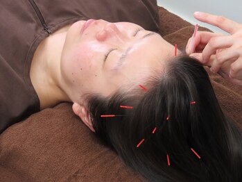とまり木鍼灸整骨院 北青山院/頭皮の鍼で血行促進