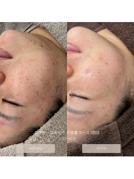 タグ 高知駅前店(Tug)/【お顔のニキビケア】