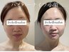 【小顔/人気NO.1】ハイパーナイフ小顔フェイシャル　15400円→
